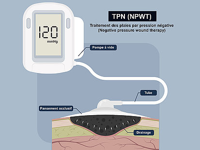 pompe-a-vide_TPN_NPWT_VAC