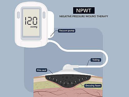 Drenaggio delle ferite con pompa a vuoto / NPWT